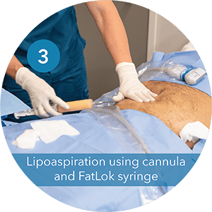 Step 3 Lipoaspiration using cannula