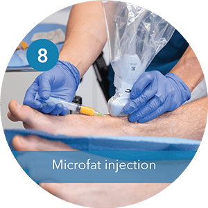 Step 8 Microfat injection