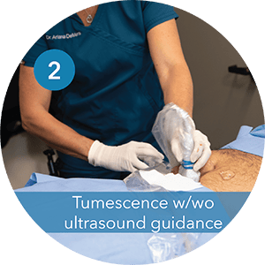 Step 2 Tumescence w/o Ultrasound